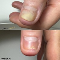 Problematický nehet palce vhodný pro podpůrnou péči ACESO